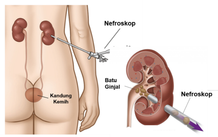 obat batu ginjal, obat penghancur batu ginjal, obat peluruh batu ginjal, obat alami batu ginjal, obat tradisional batu ginjal