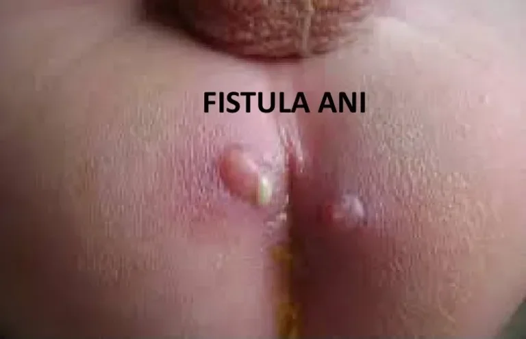 obat fistula ani, penyakit fistula ani, obat abses perianal, penyakit abses perianal