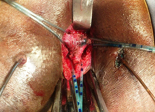obat fistula ani