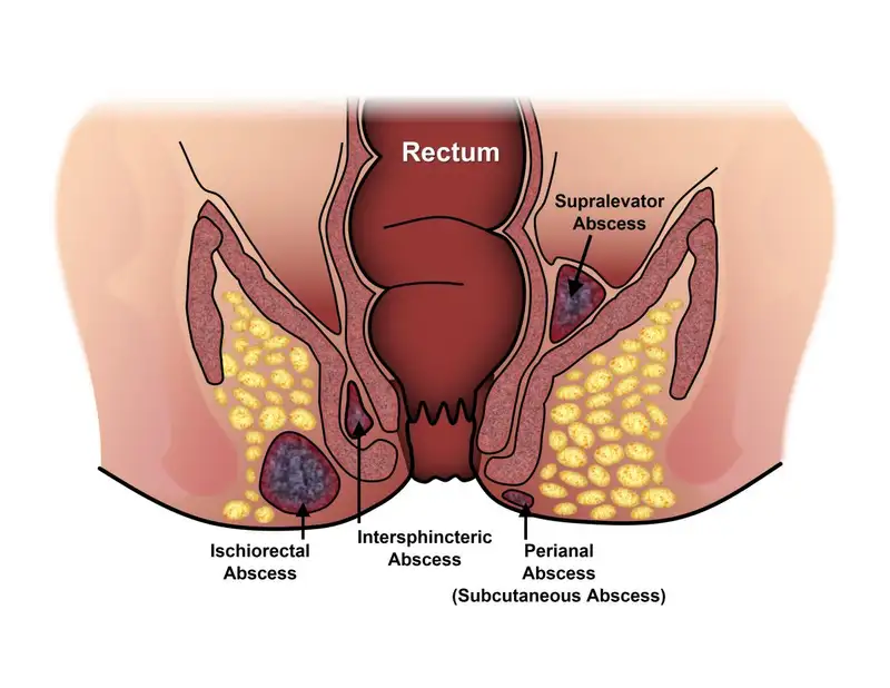 obat fistula ani