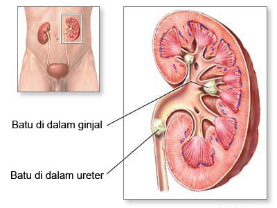 obat batu ginjal, obat batu ginjal herbal, obat penghancur batu ginjal