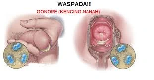 obat kencing nanah